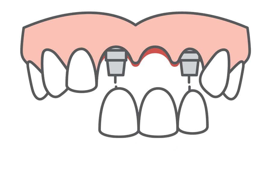 Bridge Implant Wphoto