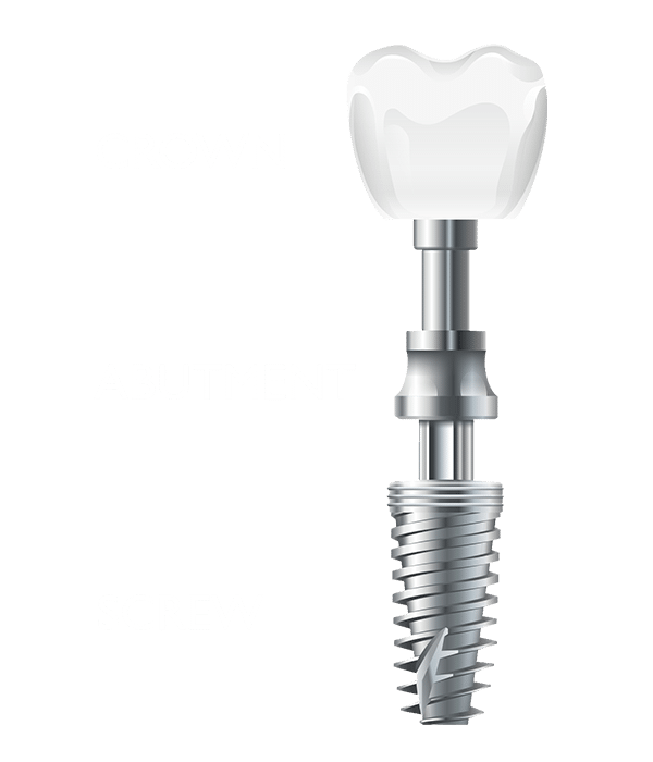 Parts Of Implant: Screw, Abutment, Crown