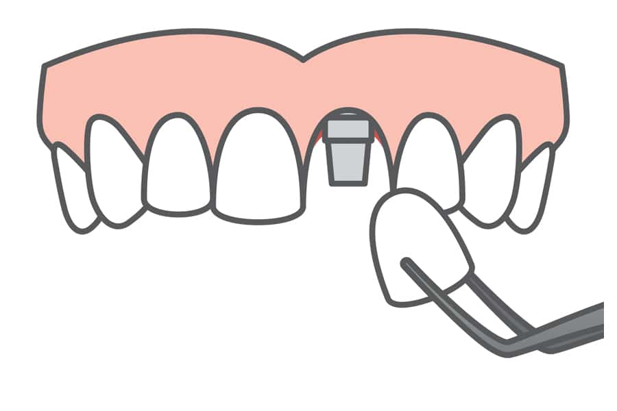 Single Implant Wphoto